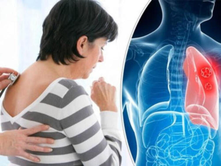 Người bị bệnh ung thư phổi thường bị ho dai dẳng, đau tức ngực, khó thở,…
